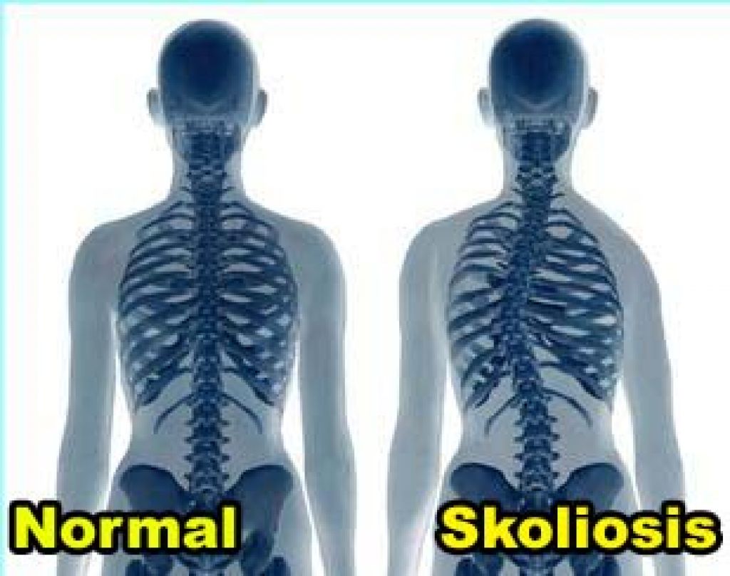 skoliosis